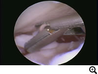 OCD/ Osteochondritisdissecans of the humeral head（離断性骨軟骨症）