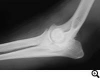 肘関節形成不全症/ FCP(内側鈎状突起分離症)