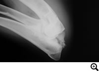 肘関節形成不全症/ FCP(内側鈎状突起分離症)