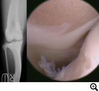 膝蓋骨脱臼グレード２〜３