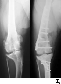 膝蓋骨脱臼グレード4