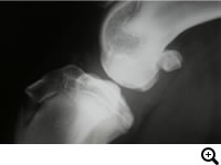 OCD(離断性骨軟骨症)