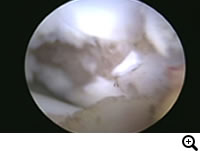 OCD(離断性骨軟骨症)