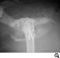 骨盤骨折、仙腸関節脱臼