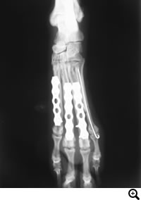 中手骨・中足骨骨折