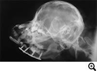 上顎骨・下顎骨骨折