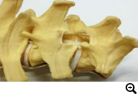 胸腰部椎間板ヘルニア