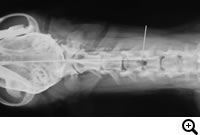 頸部椎間板ヘルニア